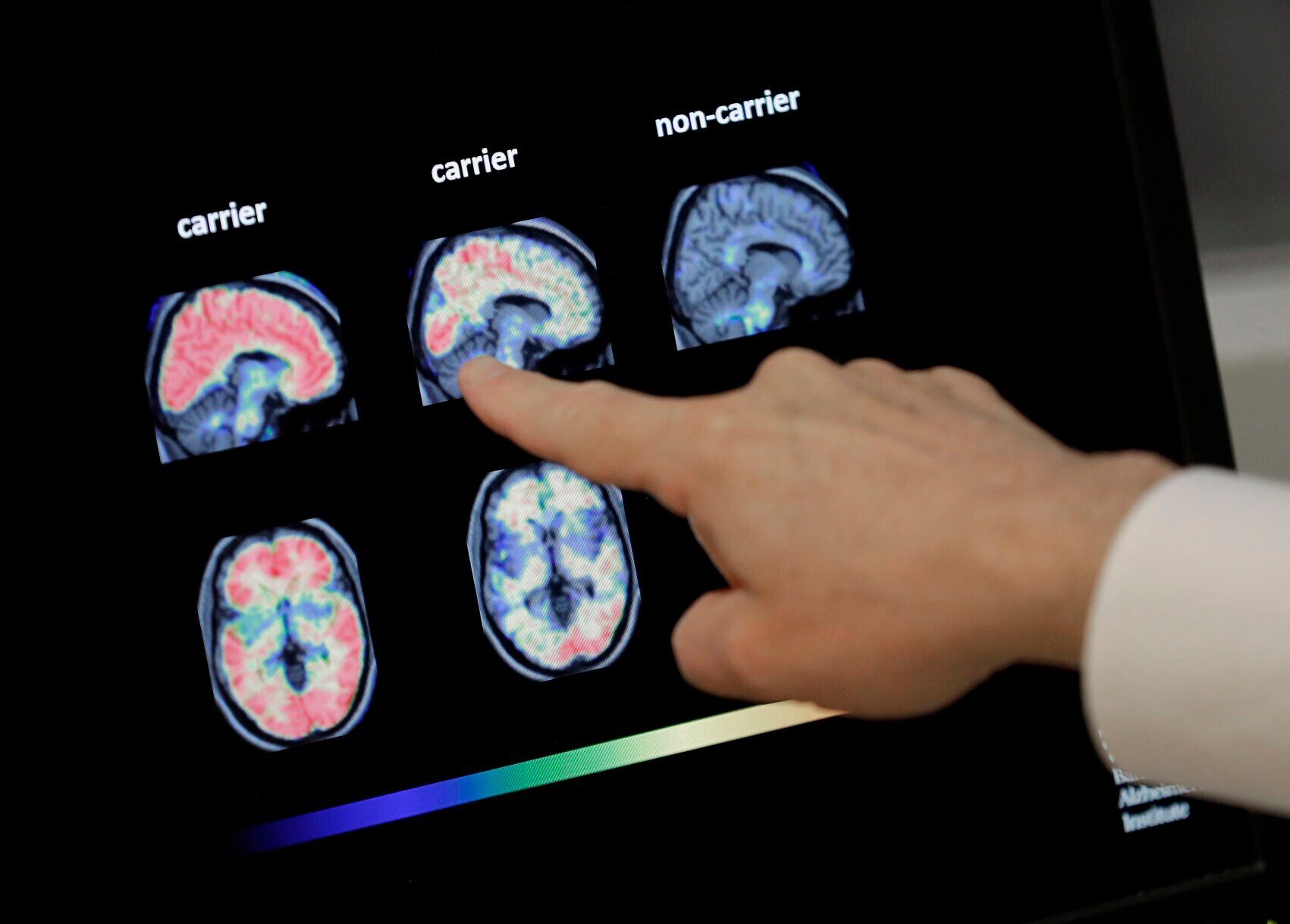 Alzheimer Brain Scans